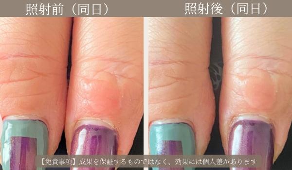 ルビッシュ照射前後の比較写真